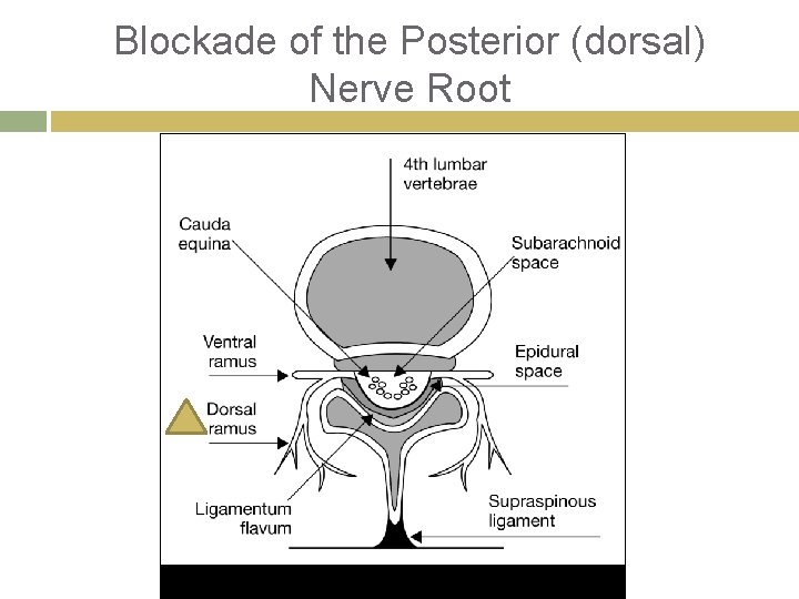 Blockade of the Posterior (dorsal) Nerve Root 