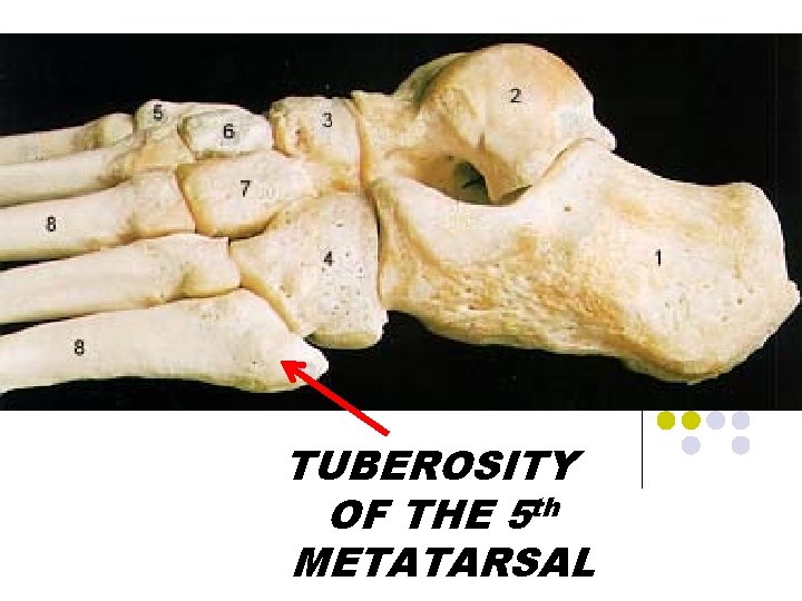 TUBEROSITY OF THE 5 th METATARSAL 