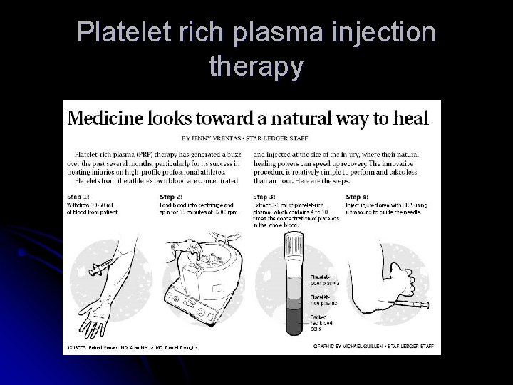 Platelet rich plasma injection therapy 