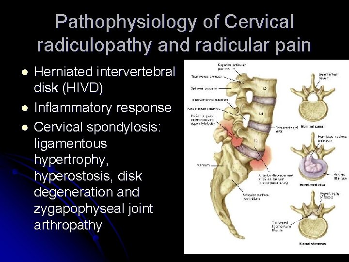 Pathophysiology of Cervical radiculopathy and radicular pain l l l Herniated intervertebral disk (HIVD)