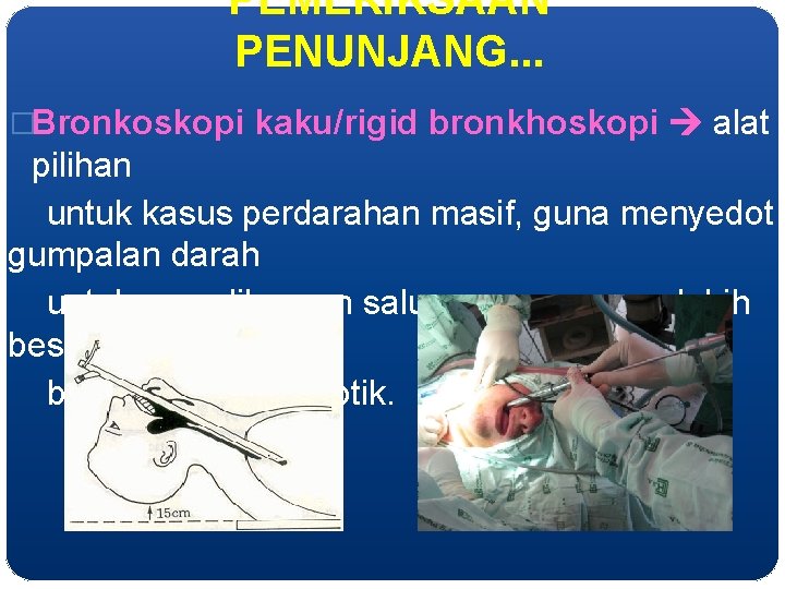 PEMERIKSAAN PENUNJANG. . . �Bronkoskopi kaku/rigid bronkhoskopi alat pilihan untuk kasus perdarahan masif, guna