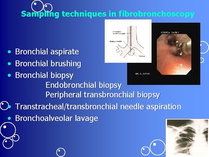 Sampling techniques in fibrobronchoscopy • • • Bronchial aspirate Bronchial brushing Bronchial biopsy Endobronchial