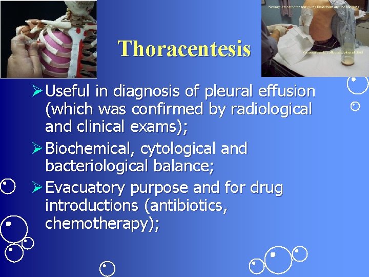 Thoracentesis Ø Useful in diagnosis of pleural effusion (which was confirmed by radiological and