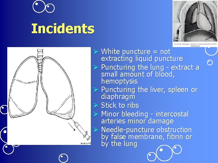 Incidents Ø White puncture = not extracting liquid puncture Ø Puncturing the lung -