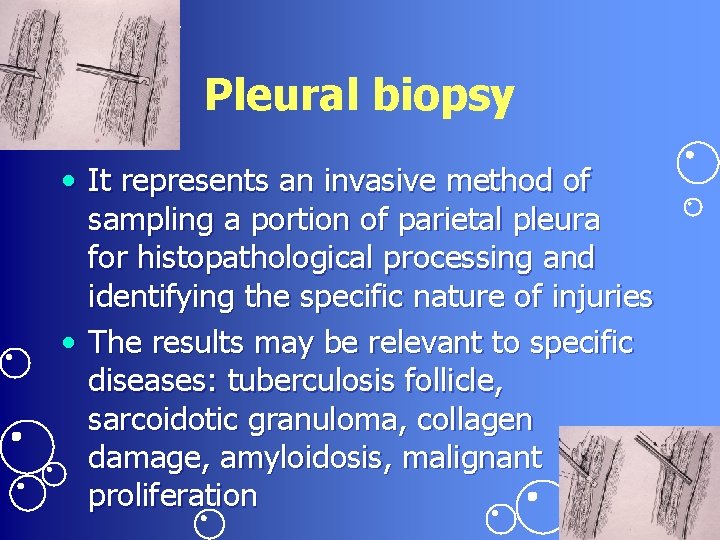 Pleural biopsy • It represents an invasive method of sampling a portion of parietal