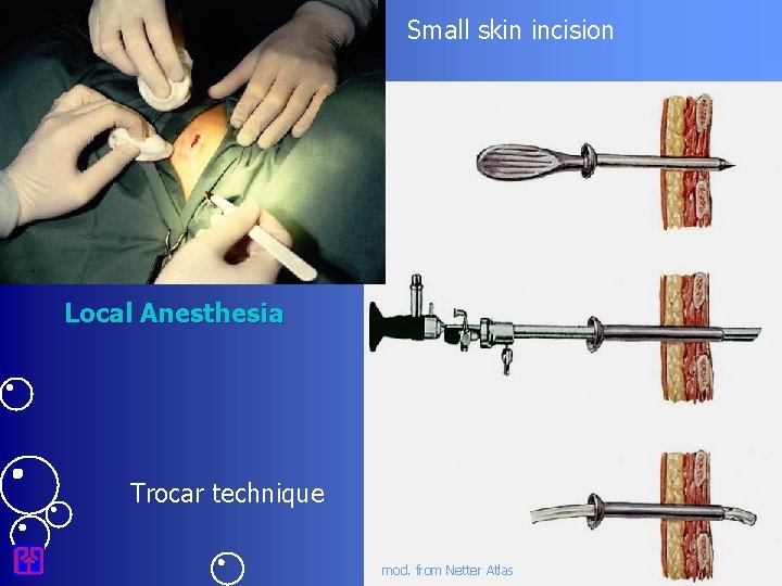 Small skin incision Local Anesthesia Trocar technique mod. from Netter Atlas 