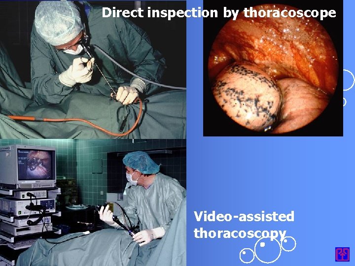Direct inspection by thoracoscope Video-assisted thoracoscopy 