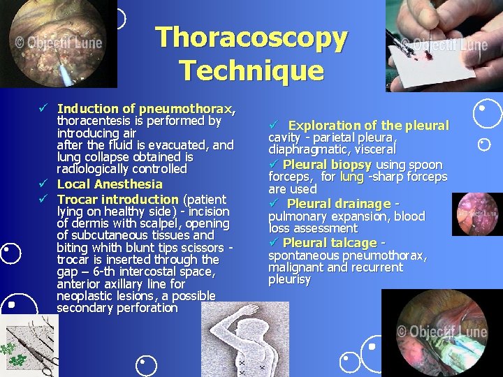 Thoracoscopy Technique ü Induction of pneumothorax, thoracentesis is performed by introducing air after the