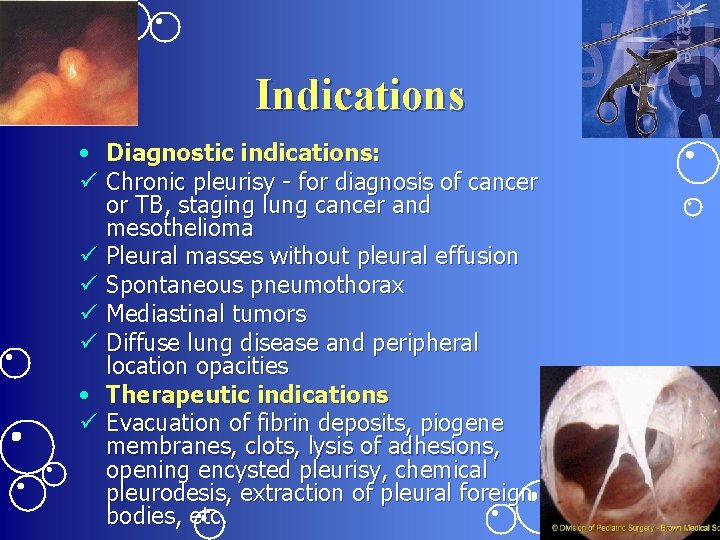 Indications • Diagnostic indications: ü Chronic pleurisy - for diagnosis of cancer or TB,