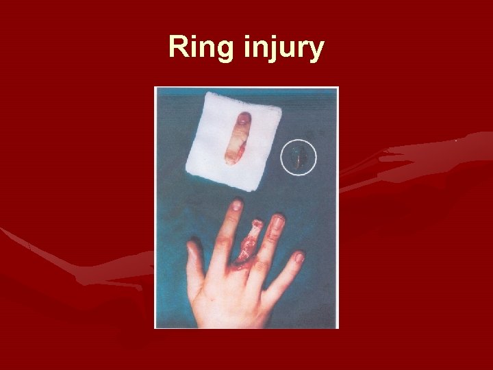 Ring injury 