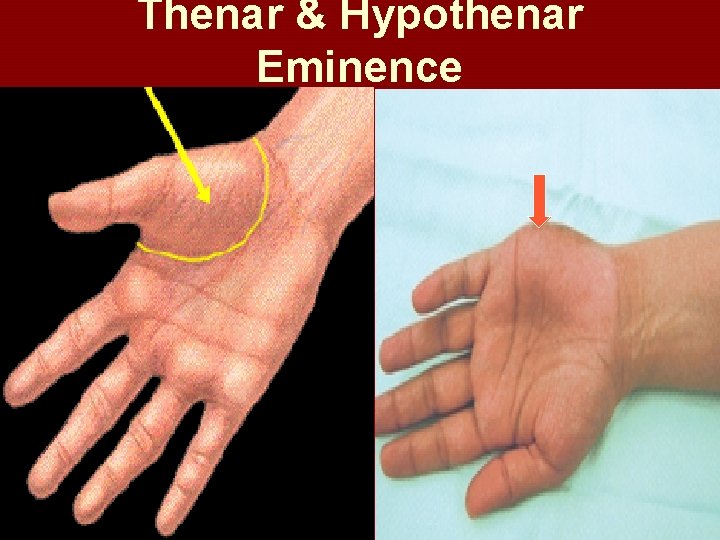 Thenar & Hypothenar Eminence 
