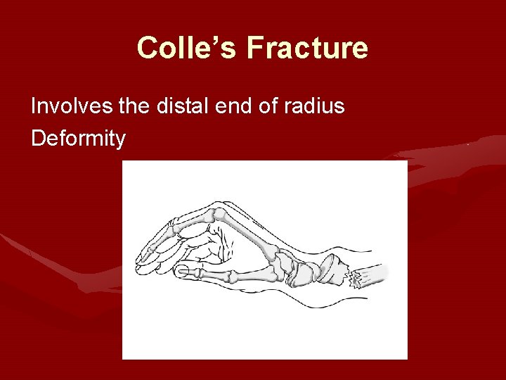 Colle’s Fracture Involves the distal end of radius Deformity 