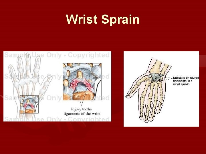 Wrist Sprain Wrist Sprain