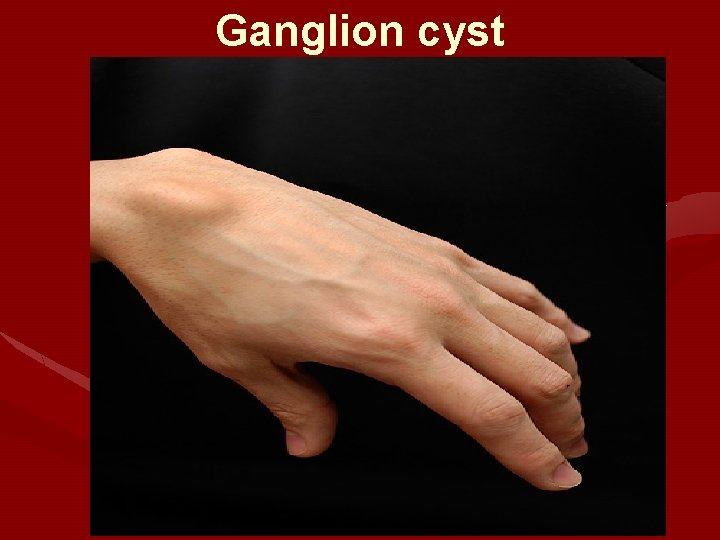 Ganglion cyst Ganglion cyst