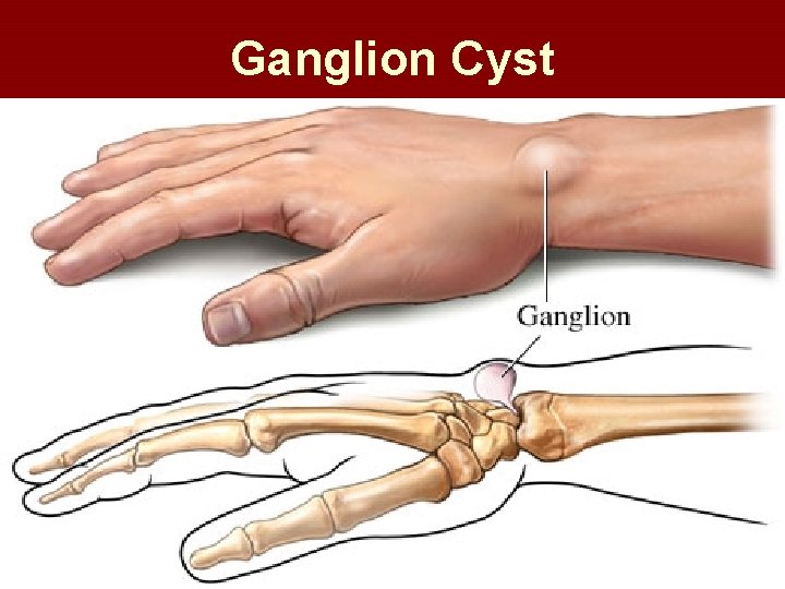 Ganglion Cyst Ganglion Cyst