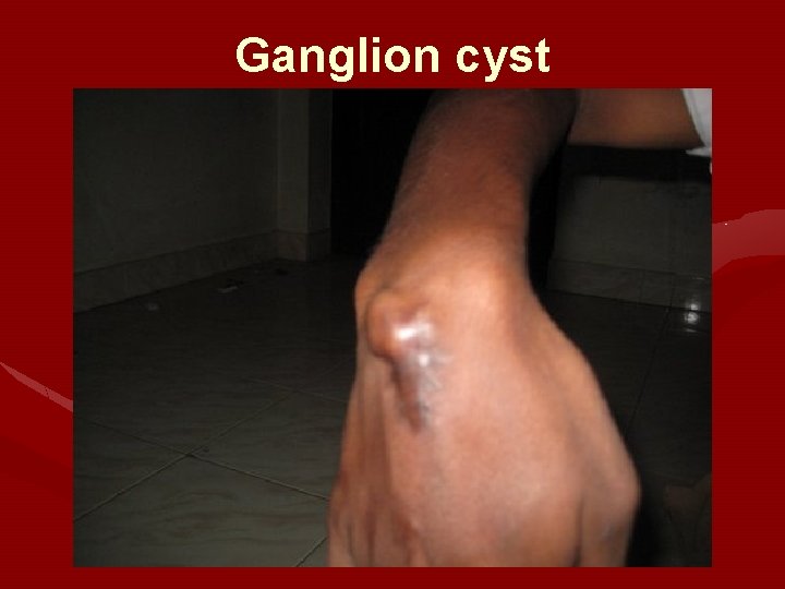 Ganglion cyst 