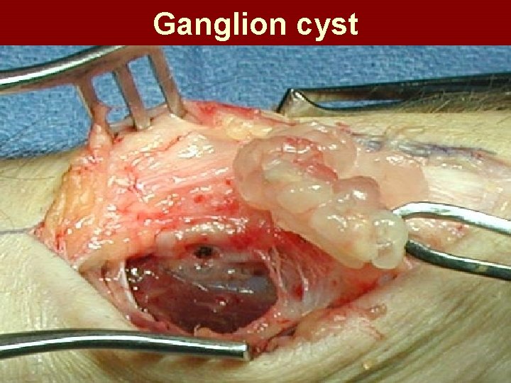 Ganglion cyst 