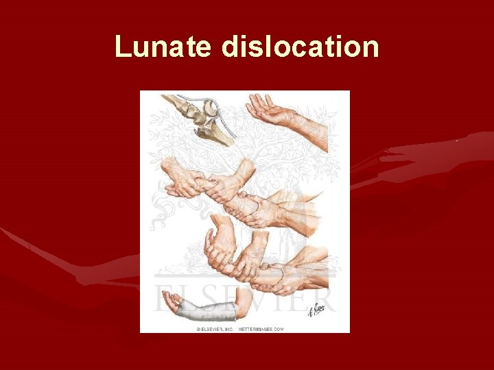 Lunate dislocation 