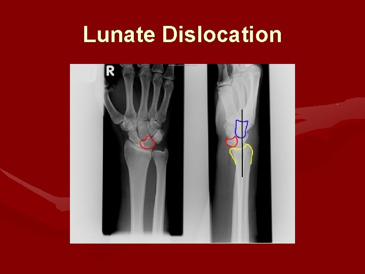 Lunate Dislocation Lunate Dislocation