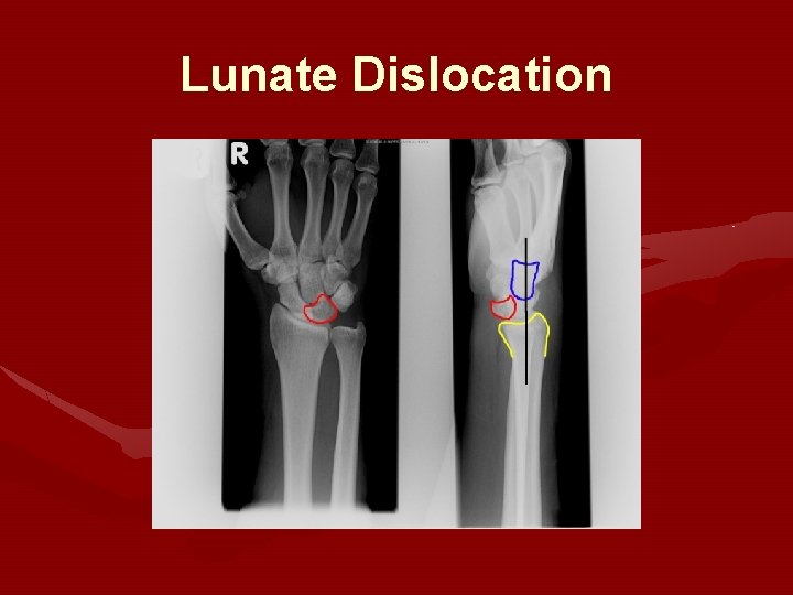 Lunate Dislocation 