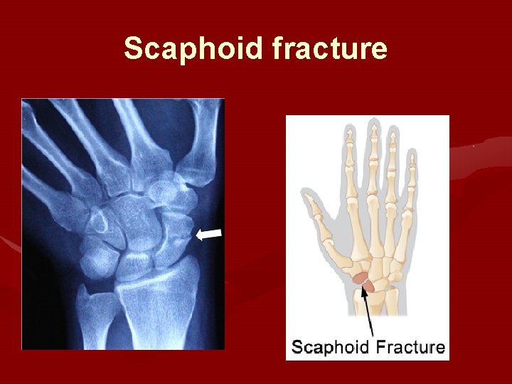 Scaphoid fracture 