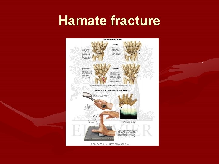 Hamate fracture 