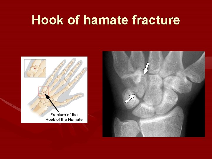 Hook of hamate fracture 