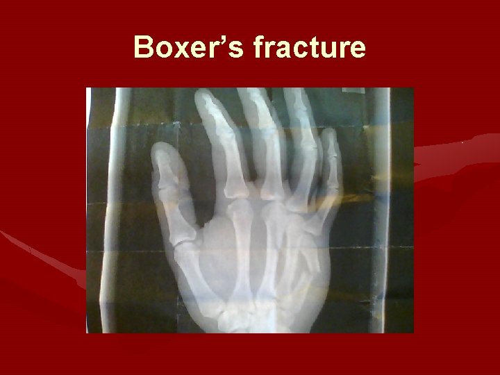 Boxer’s fracture 