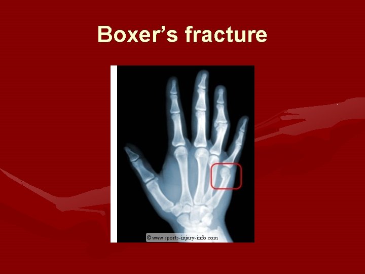 Boxer’s fracture 