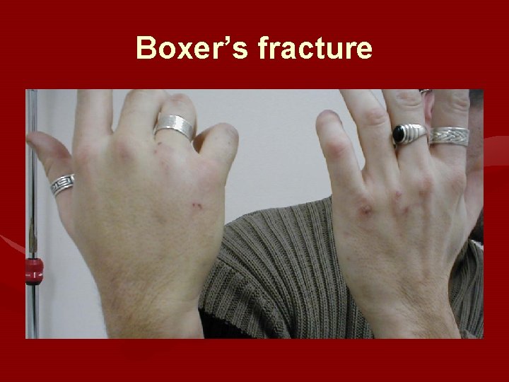 Boxer’s fracture 