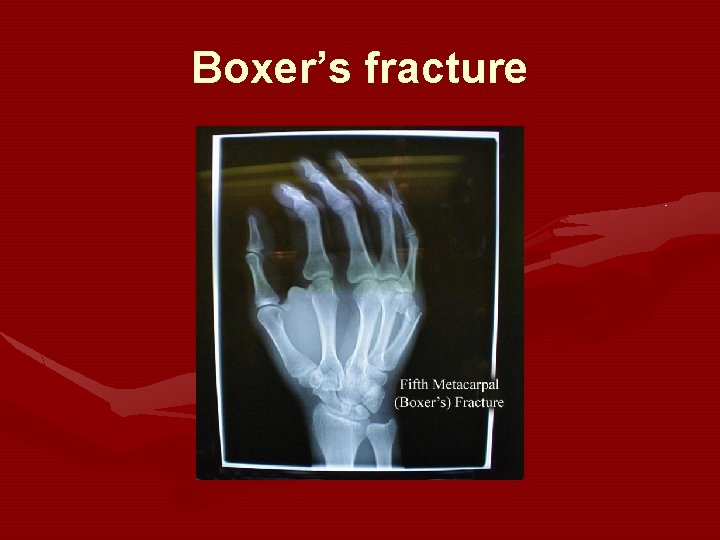 Boxer’s fracture 