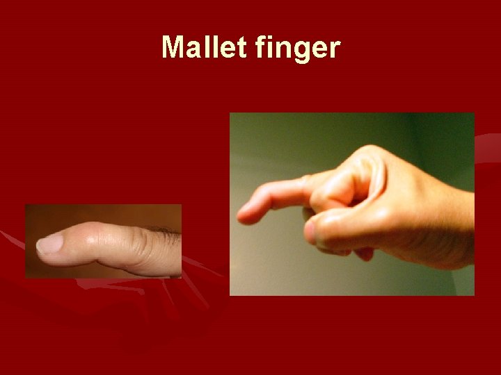 Mallet finger 