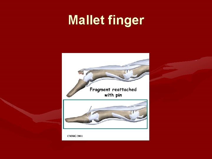 Mallet finger 