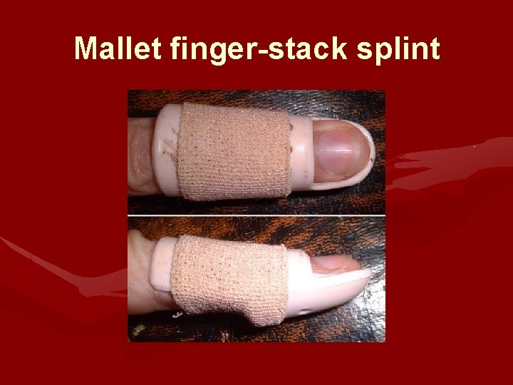Mallet finger-stack splint Mallet finger-stack splint