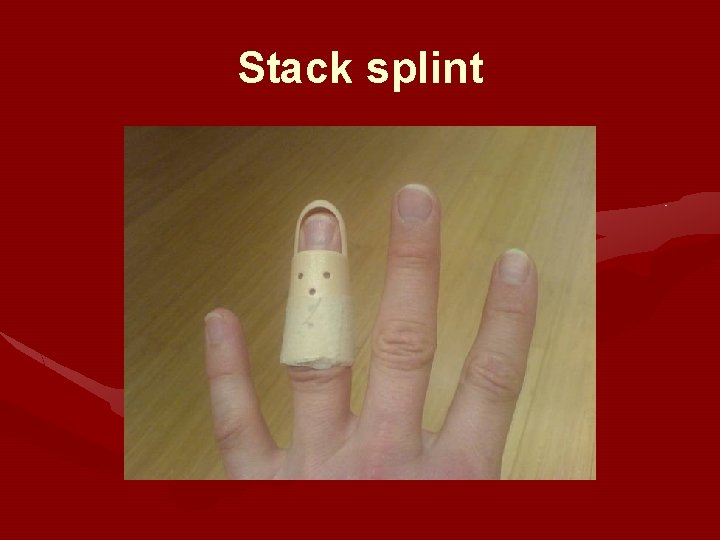 Stack splint 