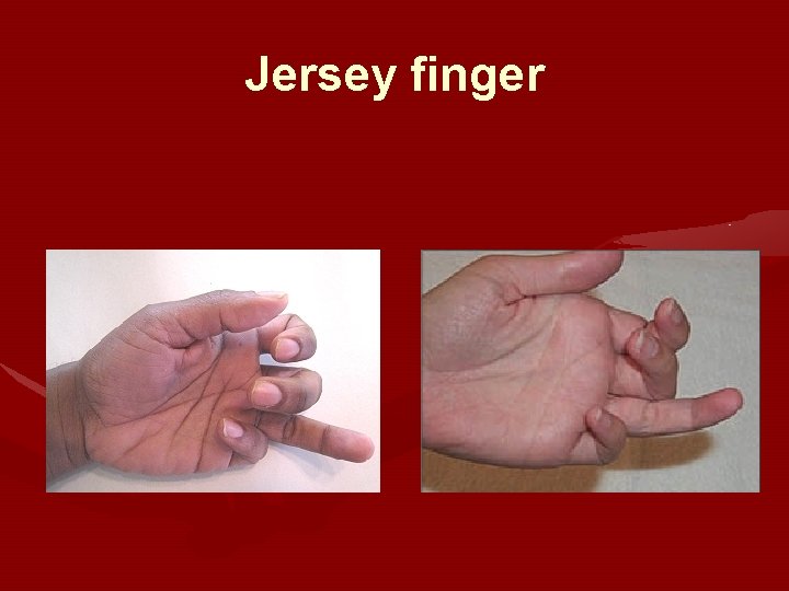 Jersey finger Jersey finger