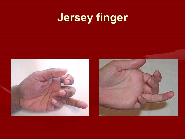 Jersey finger 