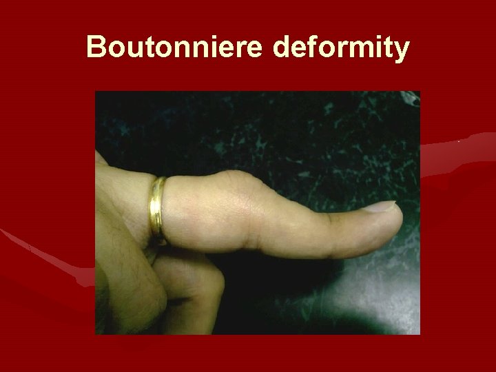 Boutonniere deformity Boutonniere deformity