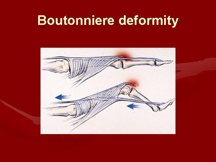 Boutonniere deformity Boutonniere deformity