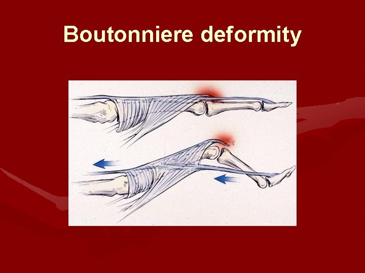 Boutonniere deformity 