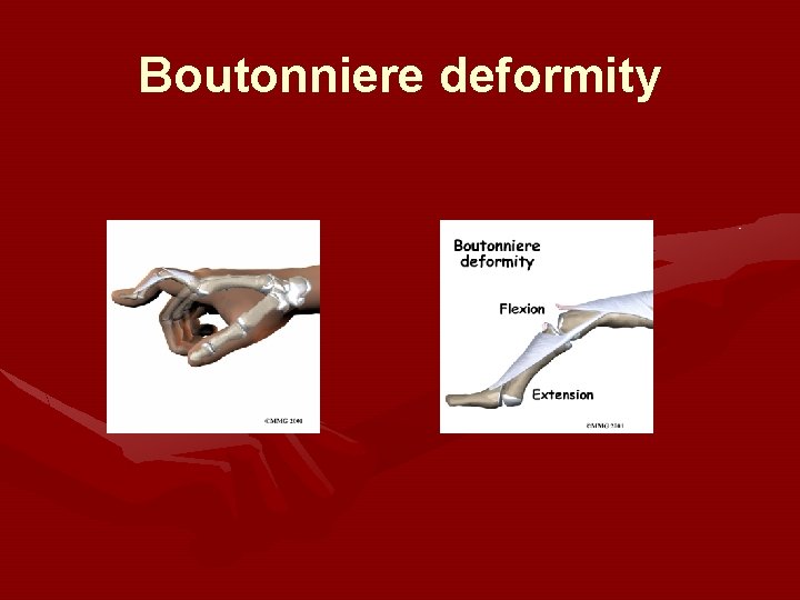 Boutonniere deformity 