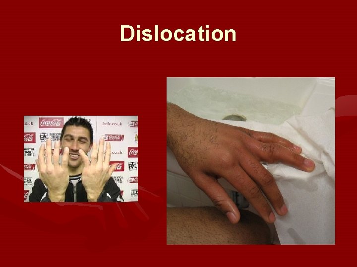 Dislocation 