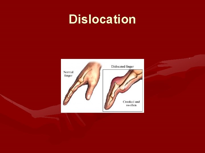 Dislocation Dislocation