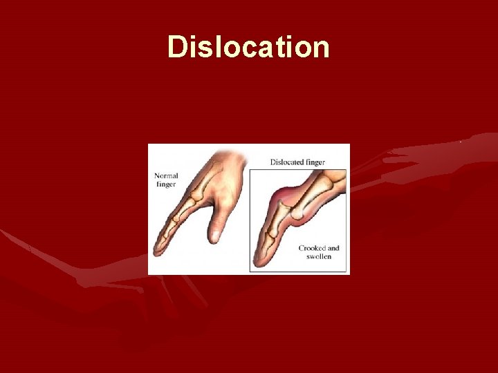 Dislocation 