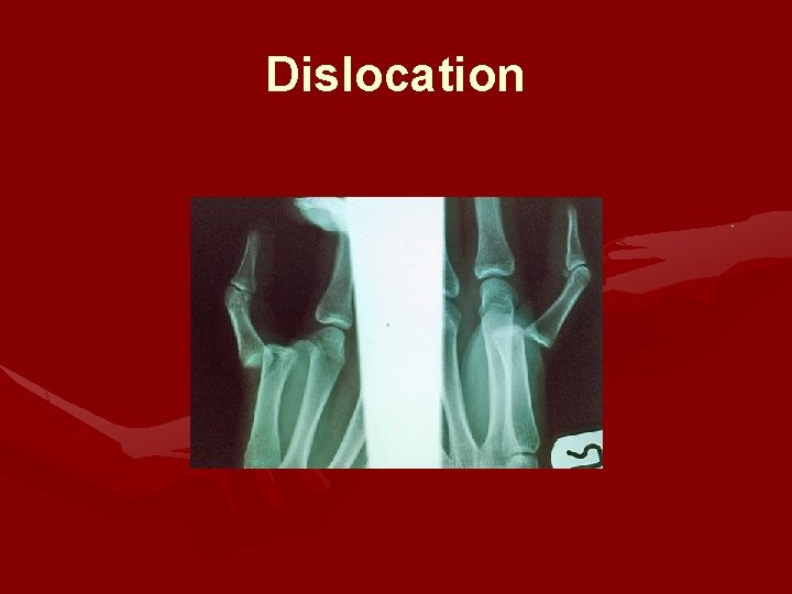 Dislocation Dislocation