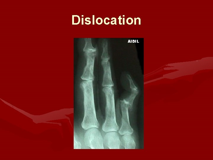 Dislocation Dislocation