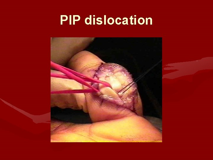 PIP dislocation PIP dislocation