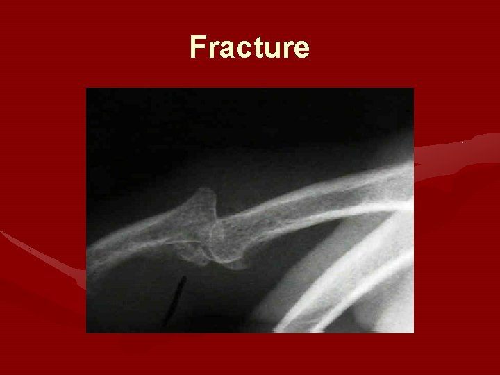 Fracture 