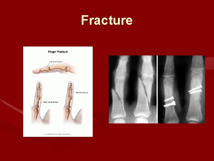 Fracture Fracture