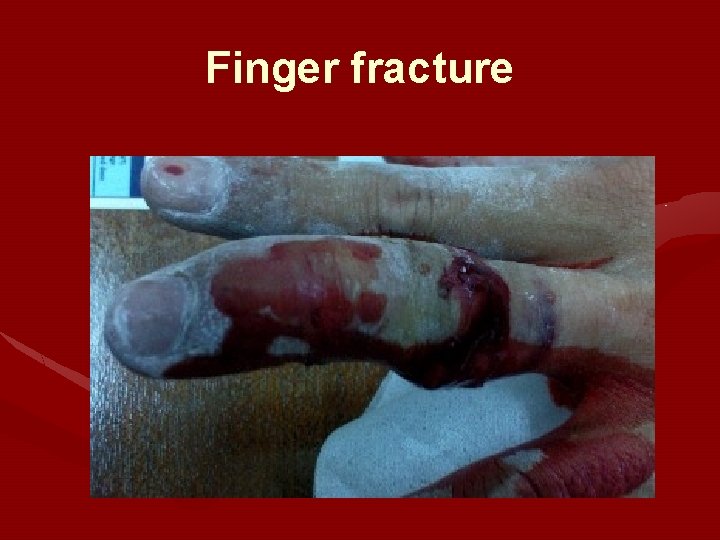 Finger fracture 